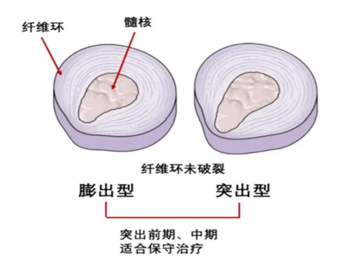 椎間盤包容